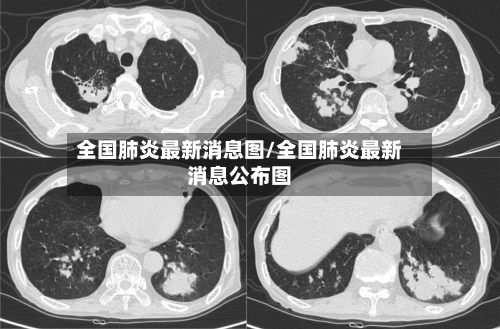 全国肺炎最新消息图/全国肺炎最新消息公布图